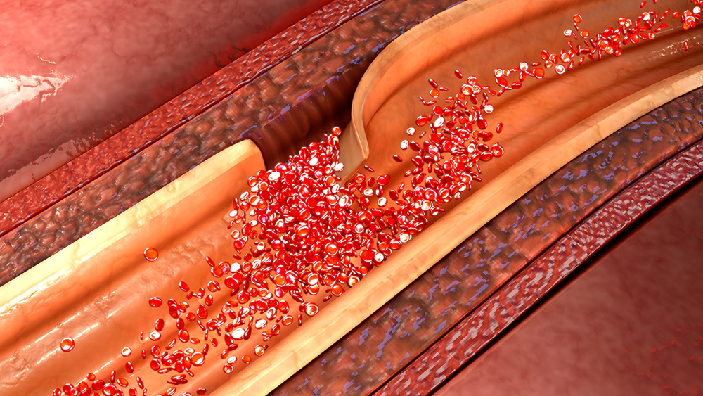 Graphic representation of aortic dissection