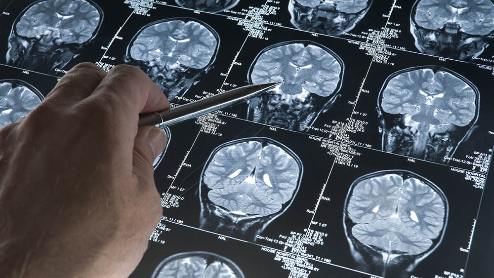 Image of MRI brain scan of head and skull with hand pointing