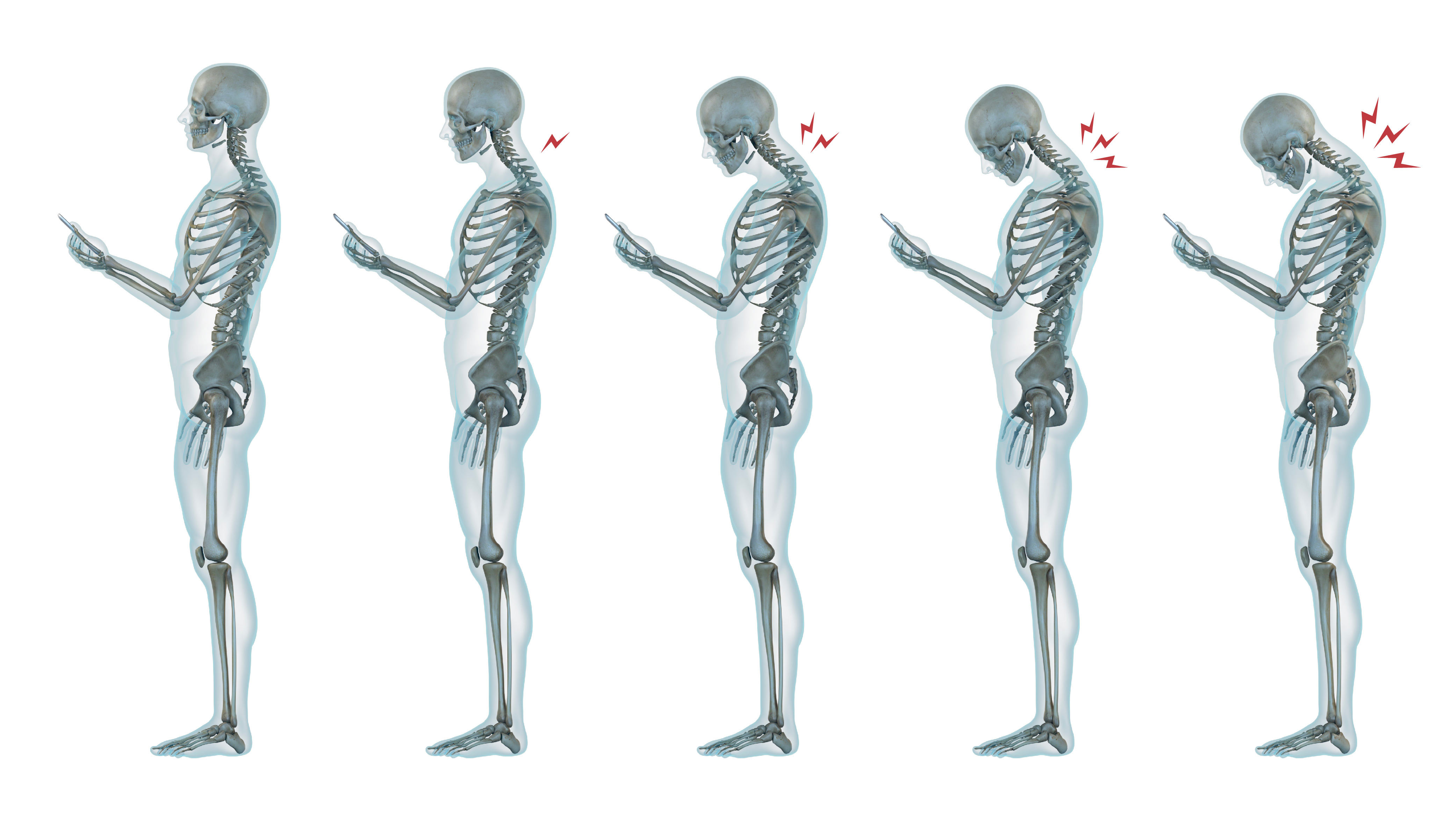 An illustration of a skeleton standing with five different head positions while looking at a phone screen. Zigzagging lines, indicating neck pain, increase the further the neck and head are bent over to look at the phone.